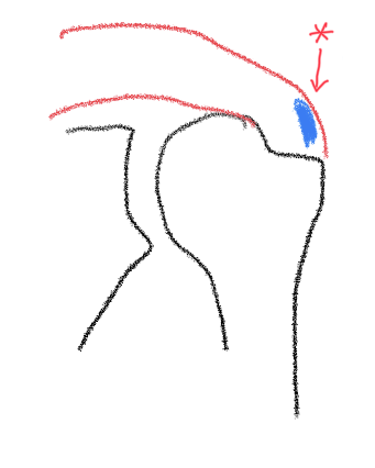 어깨 석회성건염, 석회가 있다고 모두 아픈 것은 아닙니다