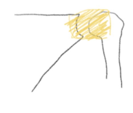 오십견 원인과 치료｜정말 50대에만 걸릴까?